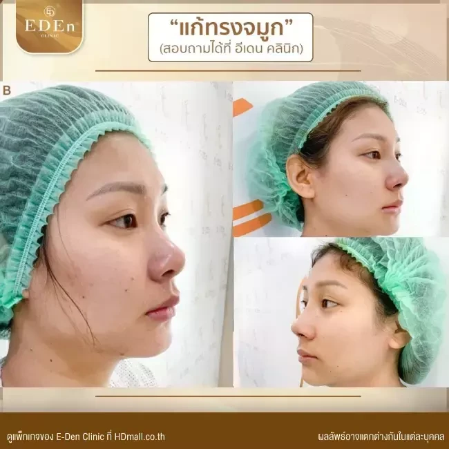 รีวิว เสริมจมูก ที่ E-Den Clinic