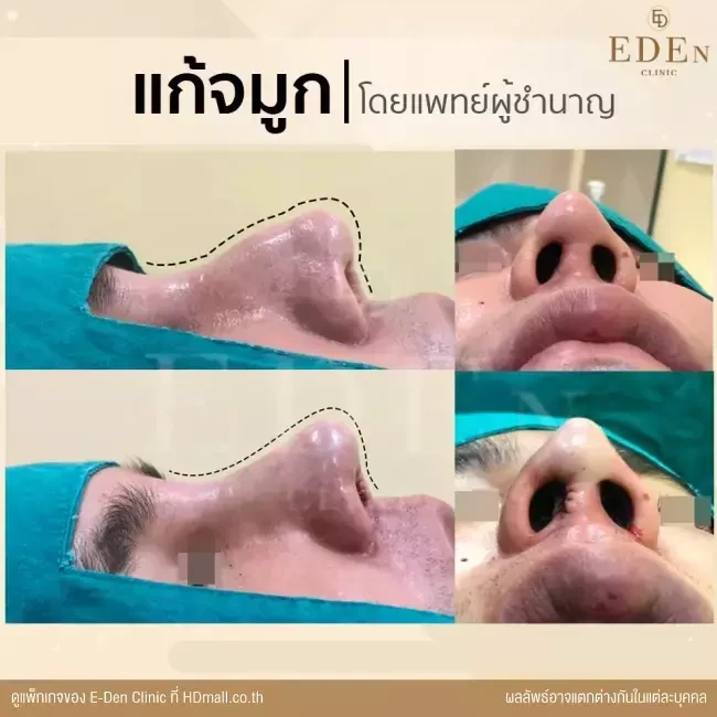 รีวิว เสริมจมูก ที่ E-Den Clinic