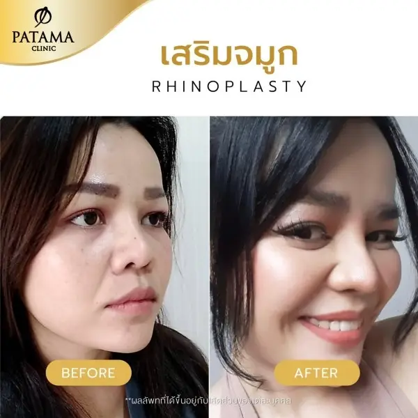 content review before after rhinoplasty teardrop shaped at patama clinic 2
