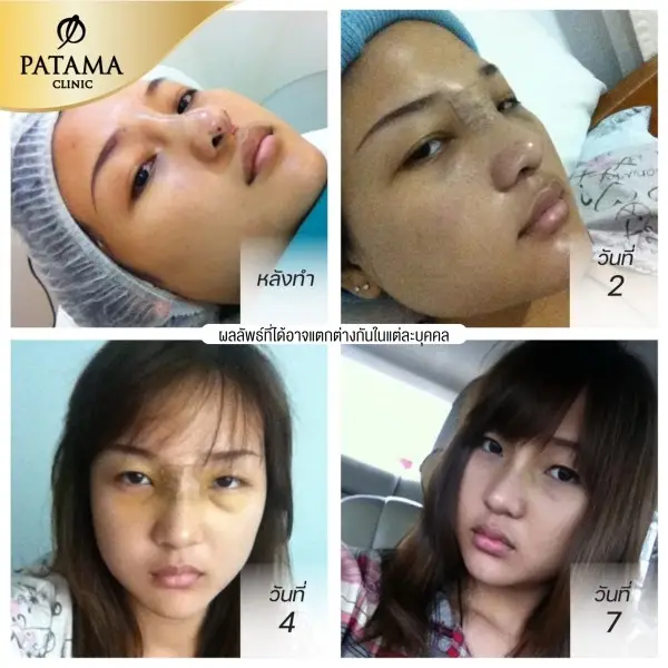 content review before after rhinoplasty teardrop shaped at patama clinic 3