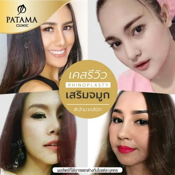 content review before after rhinoplasty teardrop shaped at patama clinic 5