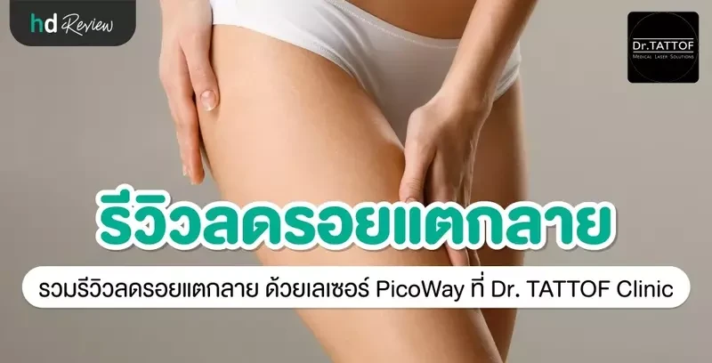 รีวิว ลดรอยแตกลาย ด้วยเลเซอร์ PicoWay ที่ Dr. TATTOF Clinic