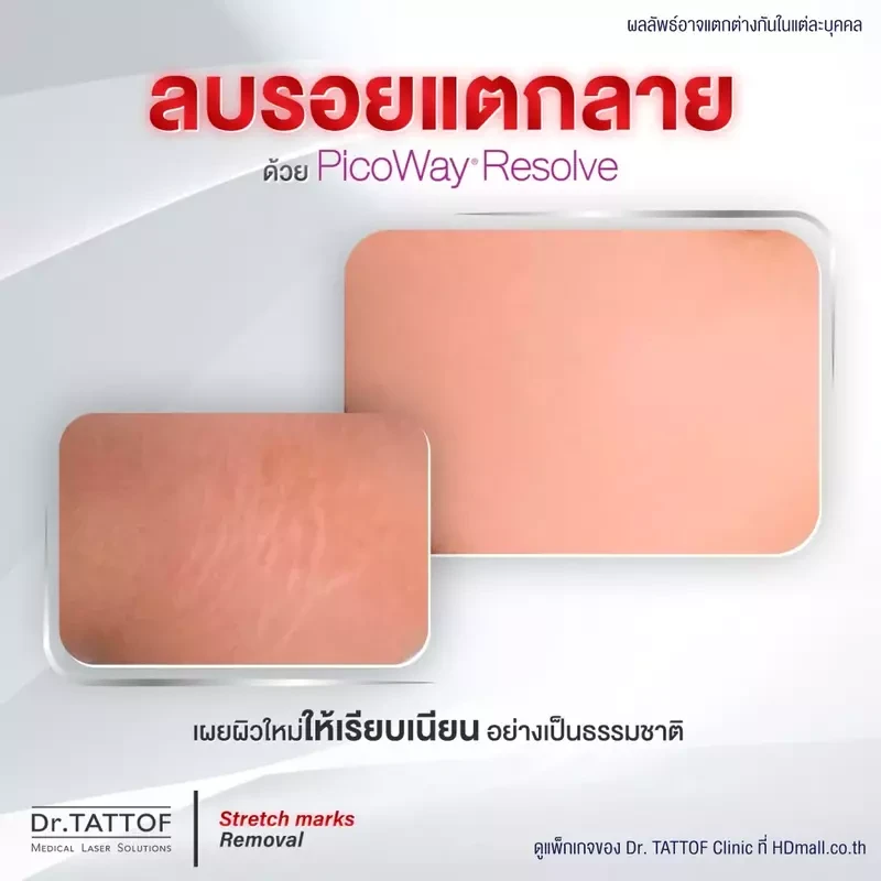 รีวิว ลดรอยแตกลาย ด้วยเลเซอร์ PicoWay ที่ Dr. TATTOF Clinic