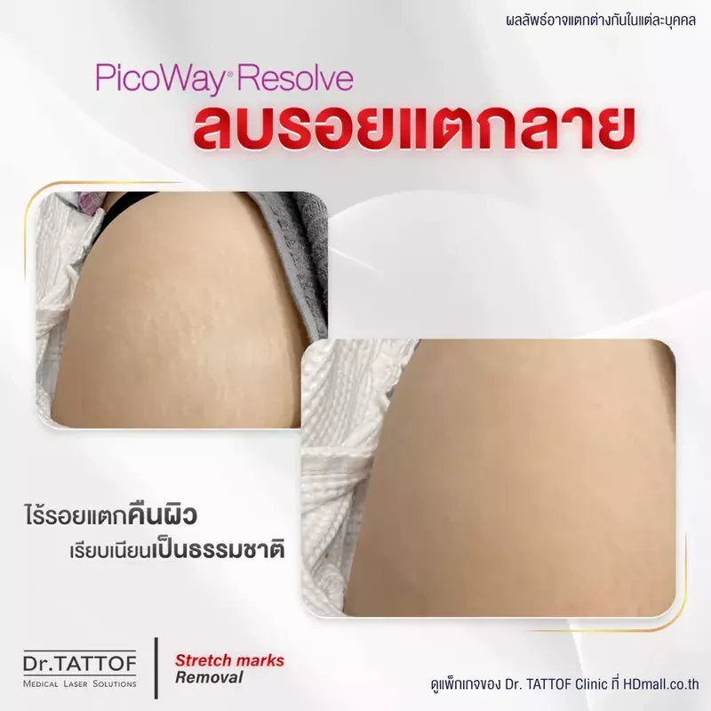รีวิว ลดรอยแตกลาย ด้วยเลเซอร์ PicoWay ที่ Dr. TATTOF Clinic