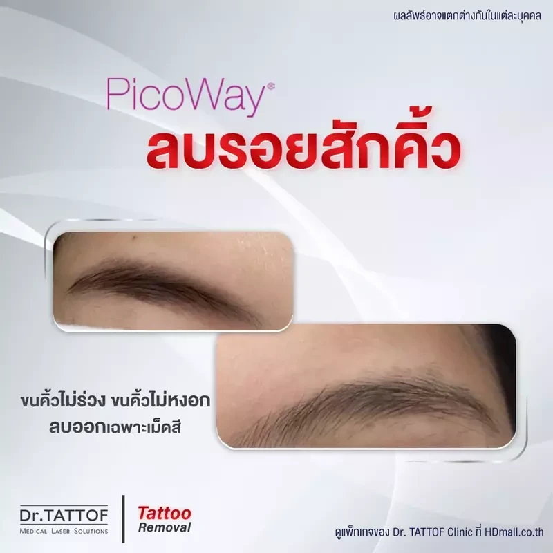 รีวิว ลบรอยสักคิ้ว ด้วยเลเซอร์ PicoWay ที่ Dr. TATTOF Clinic