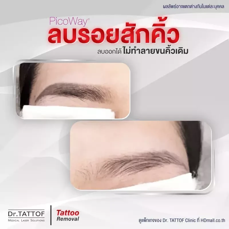 รีวิว ลบรอยสักคิ้ว ด้วยเลเซอร์ PicoWay ที่ Dr. TATTOF Clinic