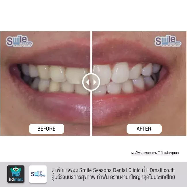 รีวิว ฟอกสีฟัน ที่ Smile Seasons Dental Clinic (คลินิกทันตกรรมสไมล์ซีซันส์)