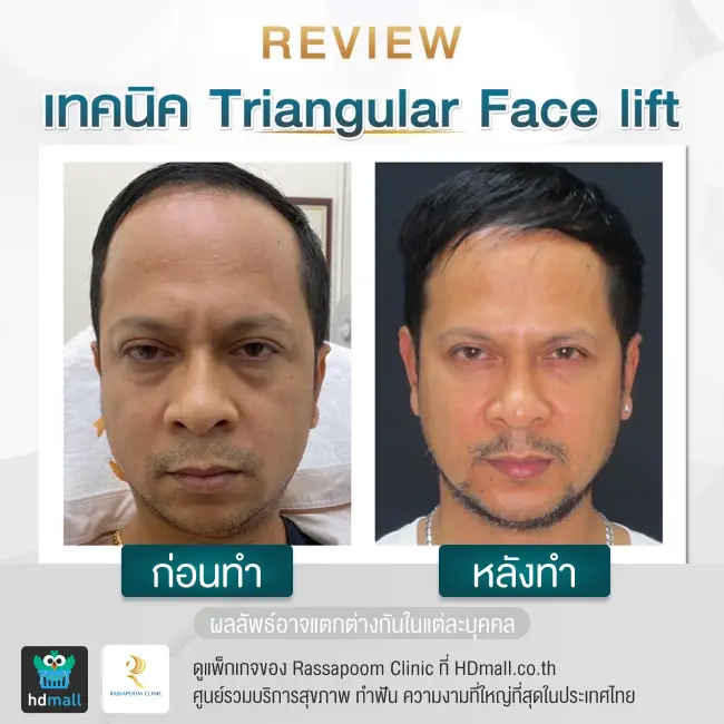 content review before after triangular face lift at rassapoom clinic 1