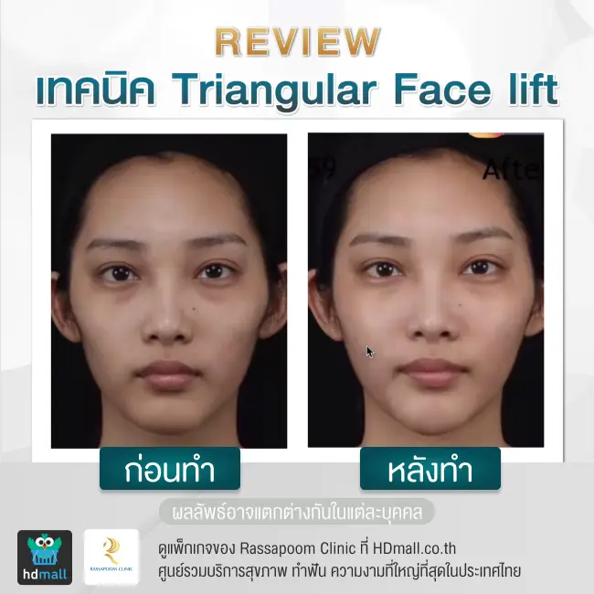 content review before after triangular face lift at rassapoom clinic 2