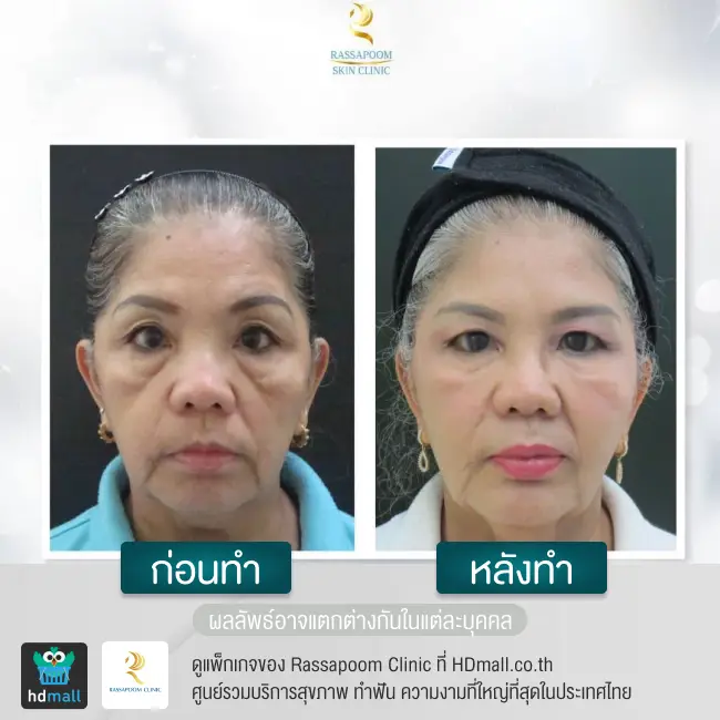 content review before after triangular face lift at rassapoom clinic 3
