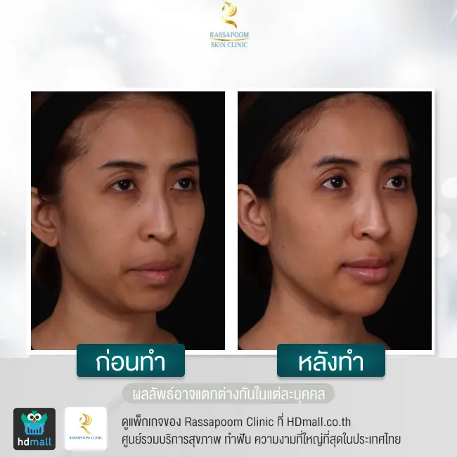 content review before after triangular face lift at rassapoom clinic 4