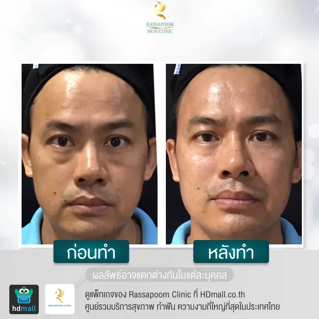 content review before after triangular face lift at rassapoom clinic 5
