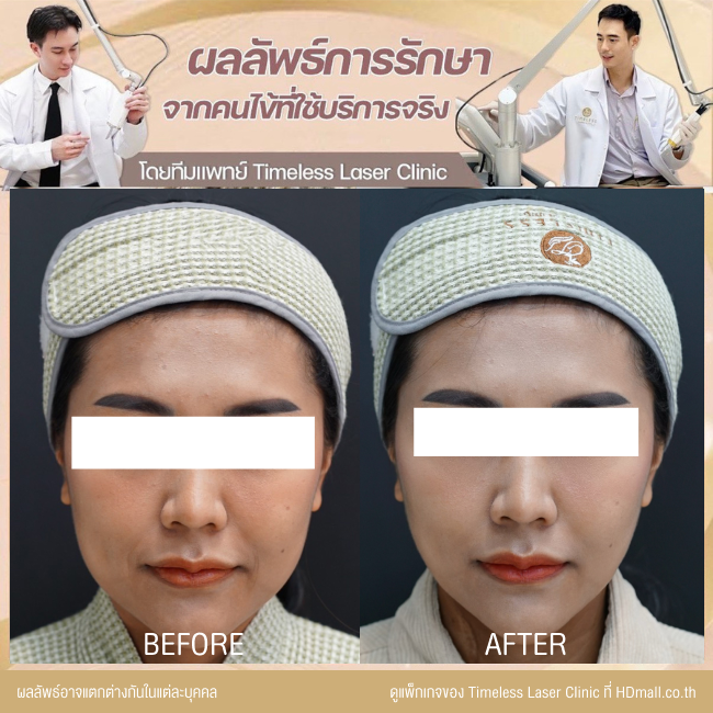 ผลลัพธ์หลังยกกระชับหน้า โปรแกรม New Ulthera SPT  ที่ Timeless Laser Clinic รูป 1