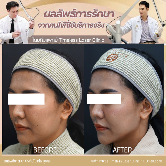 ผลลัพธ์หลังยกกระชับหน้า โปรแกรม New Ulthera SPT  ที่ Timeless Laser Clinic รูป 2