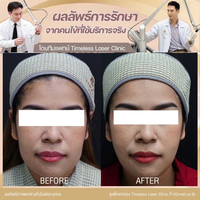 ผลลัพธ์หลังยกกระชับหน้า โปรแกรม New Ulthera SPT  ที่ Timeless Laser Clinic รูป 3