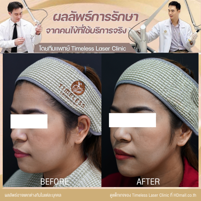 ผลลัพธ์หลังยกกระชับหน้า โปรแกรม New Ulthera SPT  ที่ Timeless Laser Clinic รูป 4