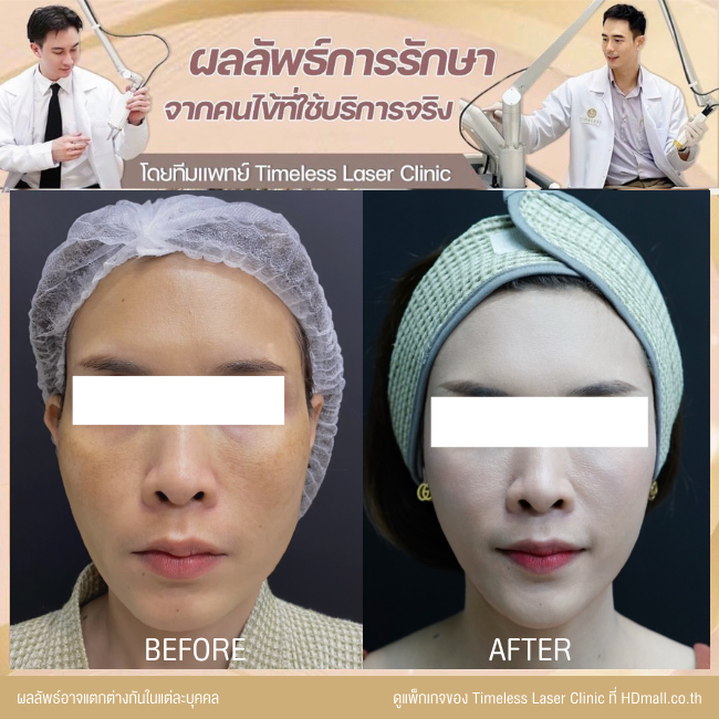 ผลลัพธ์หลังยกกระชับหน้า โปรแกรม New Ulthera SPT  ที่ Timeless Laser Clinic รูป 5