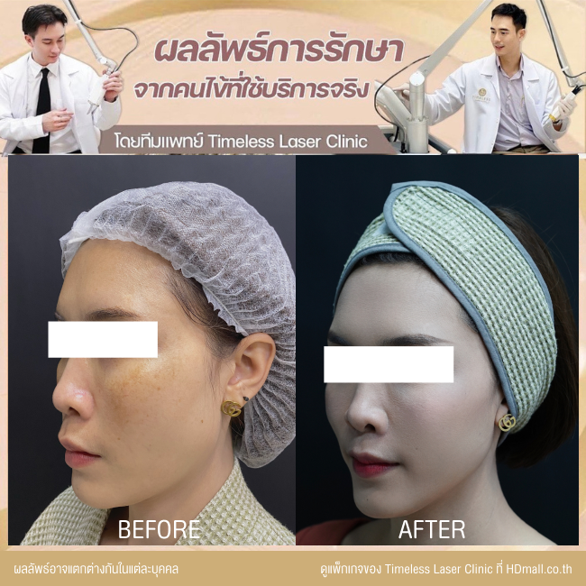 ผลลัพธ์หลังยกกระชับหน้า โปรแกรม New Ulthera SPT  ที่ Timeless Laser Clinic รูป 6