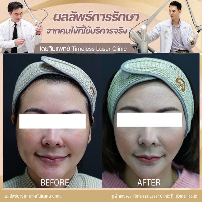 ผลลัพธ์หลังยกกระชับหน้า โปรแกรม New Ulthera SPT  ที่ Timeless Laser Clinic รูป 7