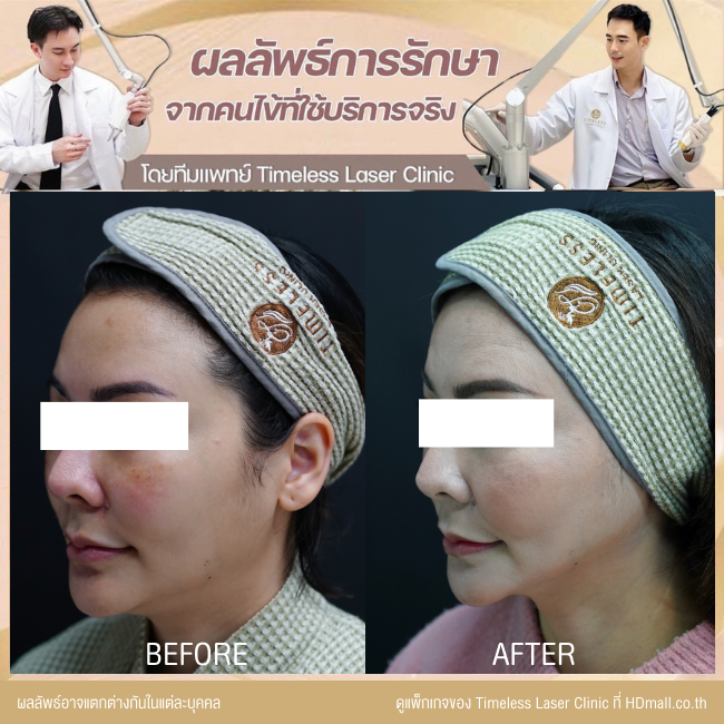 ผลลัพธ์หลังยกกระชับหน้า โปรแกรม New Ulthera SPT  ที่ Timeless Laser Clinic รูป 8