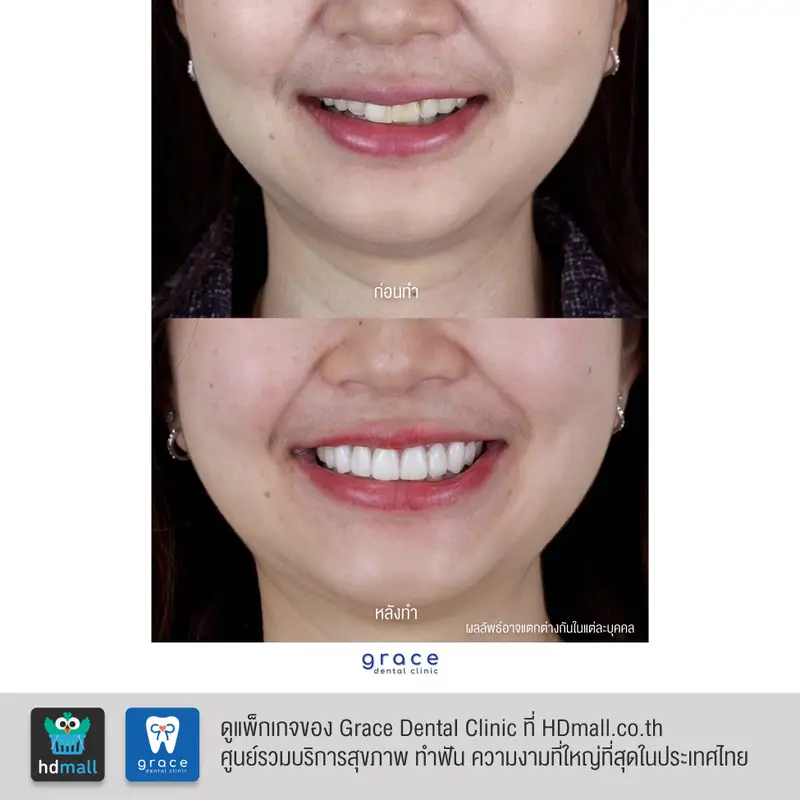 รีวิว ทำวีเนียร์ ที่ Grace Dental Clinic รูป 6