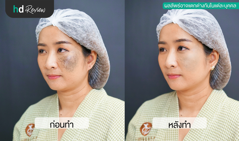 ผลลัพธ์หลังเลเซอร์ปานดำ ด้วยโปรแกรม Pico Enlighten