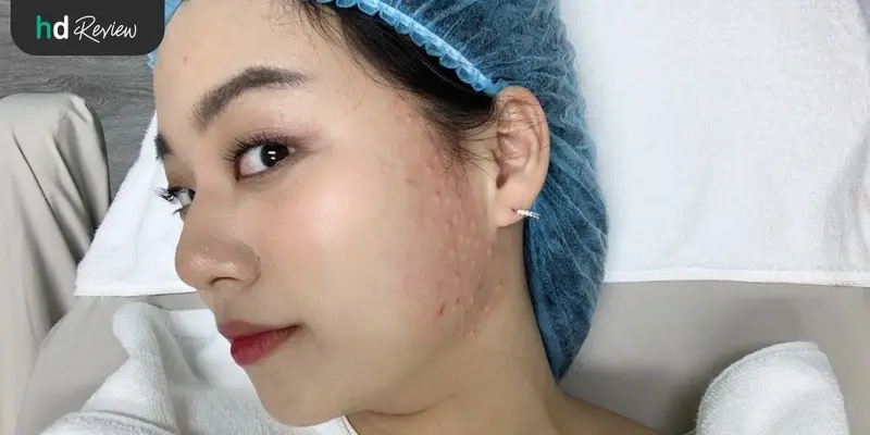 รีวิวลดกราม ทำหน้าเล็ก ด้วย Botulinum Toxin ที่ LV Aesthetic By Dr.Lucy