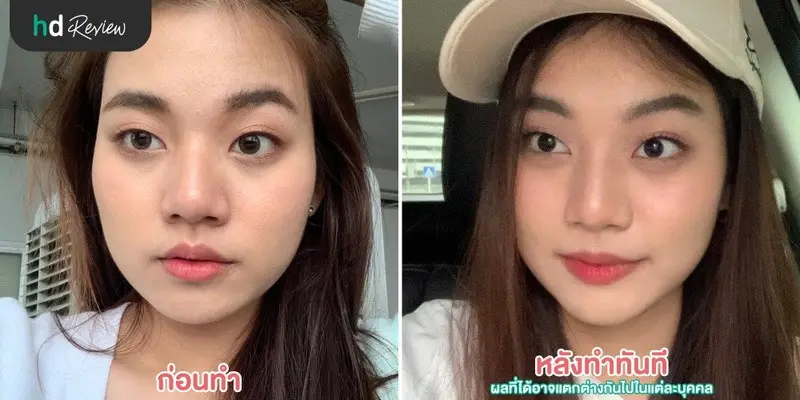 content review botulinum toxin at lv aesthetic by dr lucy by fon vongvorachate 5