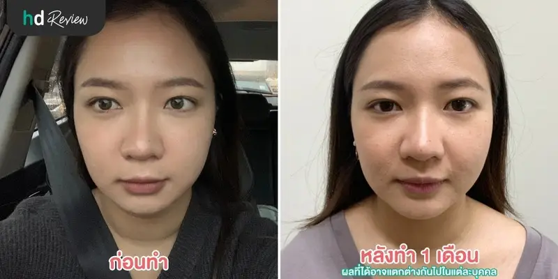 รีวิวฉีด Botulinum Toxin ลิฟท์กรอบหน้า ที่ LV Aesthetic By Dr.Lucy