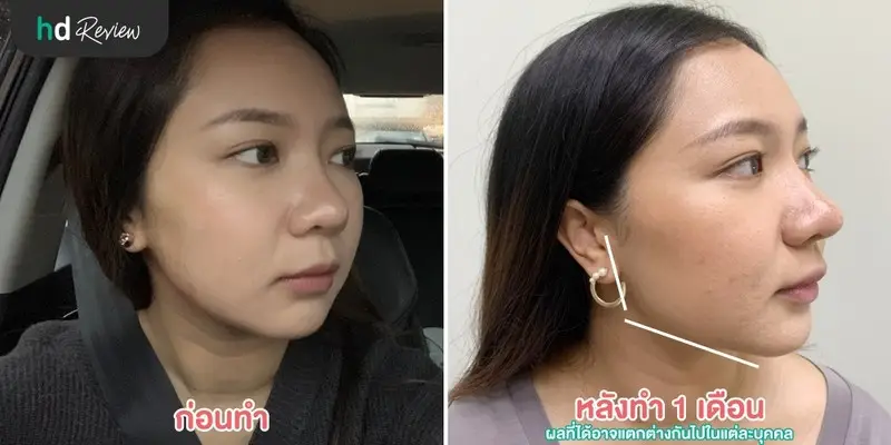 รีวิวฉีด Botulinum Toxin ลิฟท์กรอบหน้า ที่ LV Aesthetic By Dr.Lucy