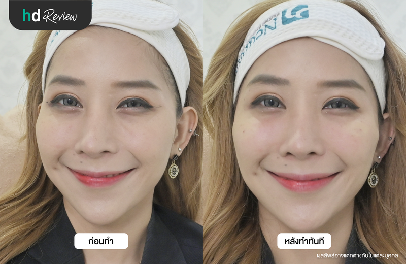 ภาพเปรียบเทียบผลลัพธ์ก่อนและหลังฉีดสลายฟิลเลอร์