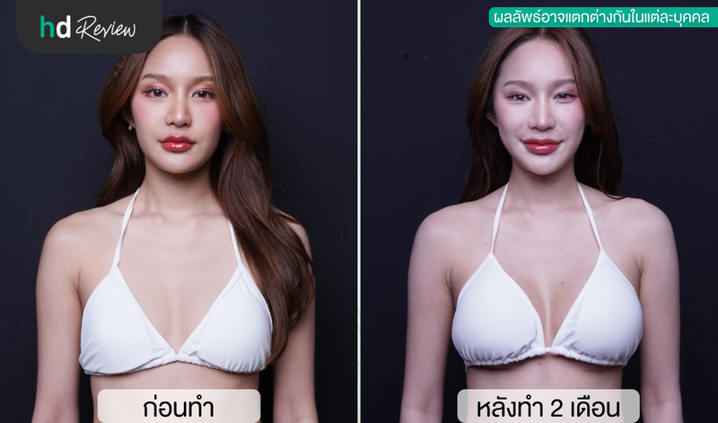 เปรียบเทียบก่อนและหลังทำหน้าอกที่ Vincent Clinic กับหมอแบค หน้าตรง
