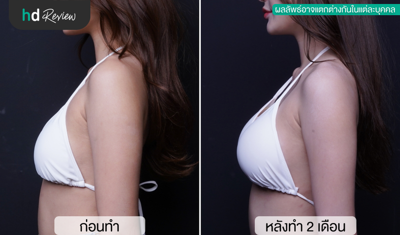 เปรียบเทียบก่อนและหลังทำหน้าอกที่ Vincent Clinic กับหมอแบค ด้านข้าง