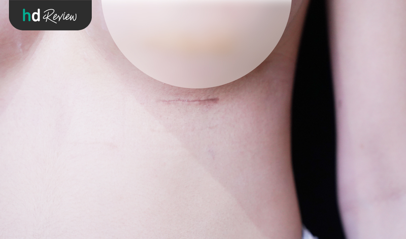 แผลผ่าตัดทำหน้าอกที่ Vincent Clinic กับหมอแบค