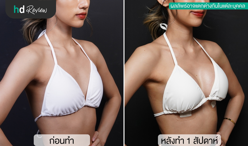 เปรียบเทียบก่อนและหลังทำนมกับหมอแบคที่ Vincent Clinic ด้านข้าง