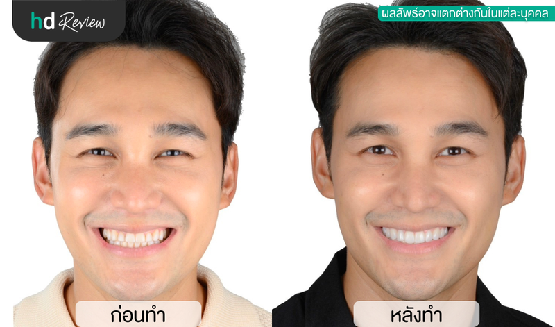 content review ceramic veneer at phyathai 2 hospital by techin chayuti 10