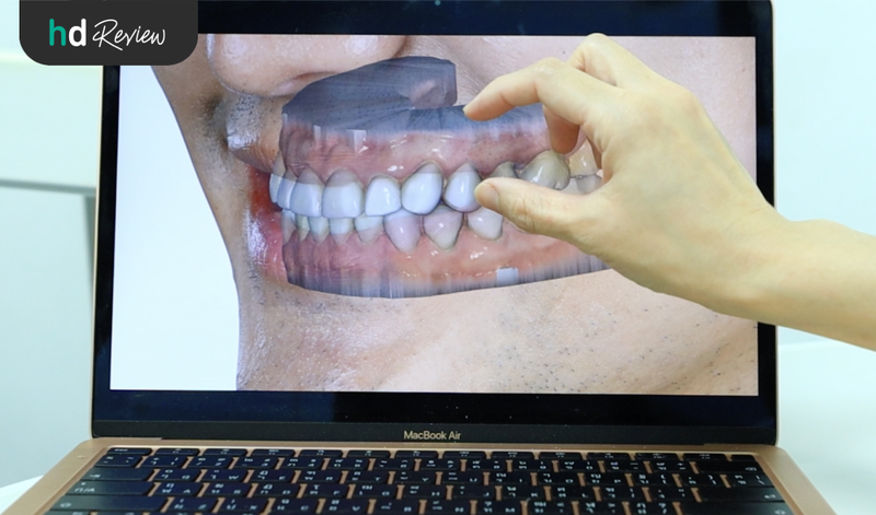 content review ceramic veneer at phyathai 2 hospital by techin chayuti 12
