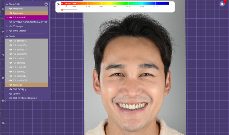 content review ceramic veneer at phyathai 2 hospital by techin chayuti 3