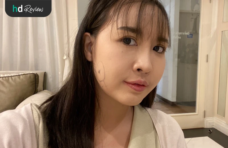 วาดหน้าก่อนผ่าตัดไขมันกระพุ้งแก้ม ที่ HERS Clinic