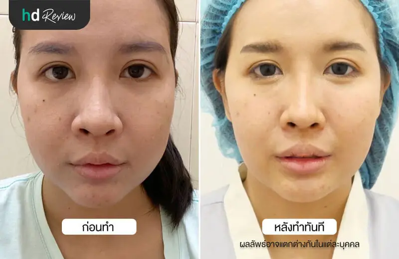 เปรียบเทียบก่อนและหลังผ่าตัดไขมันกระพุ้งแก้ม ที่ HERS Clinic