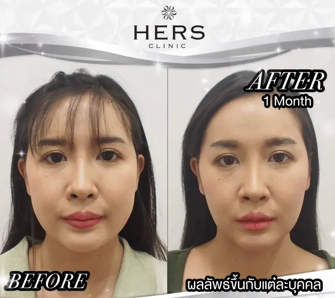 เปรียบเทียบก่อนและหลังผ่าตัดไขมันกระพุ้งแก้ม ที่ HERS Clinic