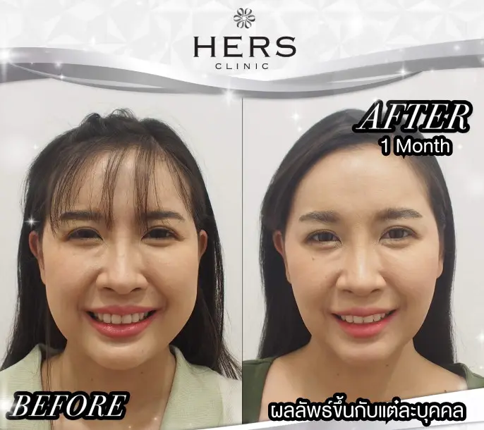 เปรียบเทียบก่อนและหลังผ่าตัดไขมันกระพุ้งแก้ม ที่ HERS Clinic