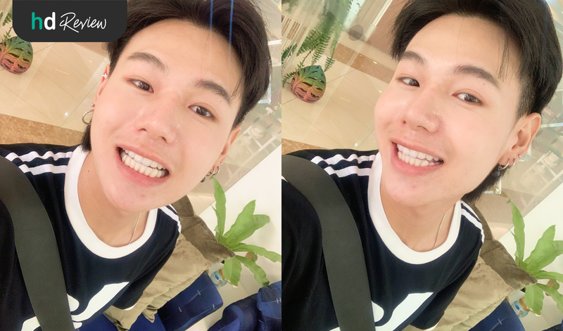 ทำรีเทนเนอร์แบบใส ที่ไหนดี?