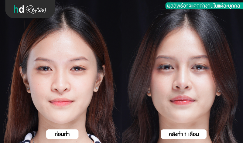 ผลลัพธ์หลังเสริมจมูก ที่ Sowon Clinic