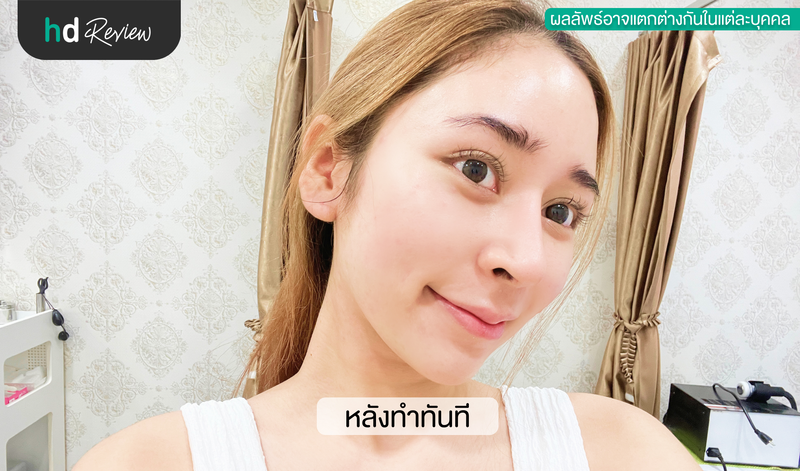ผลลัพธ์หลังทำ Cryo Treatment