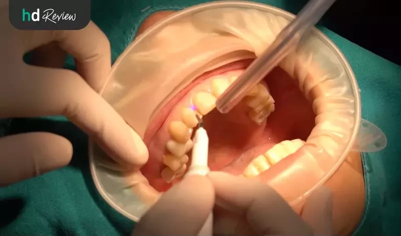 ขั้นตอนการตัดเหงือกด้วยเลเซอร์ ที่ Grace Dental Clinic