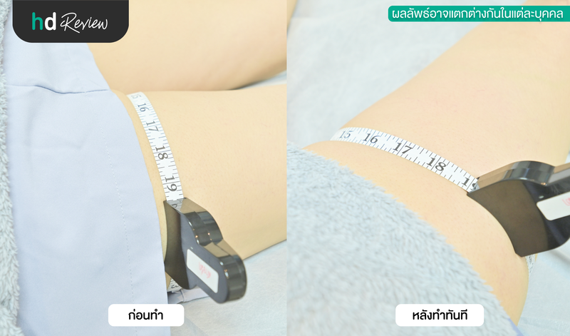 ผลลัพธ์หลังทำ Exilis Ultra 360