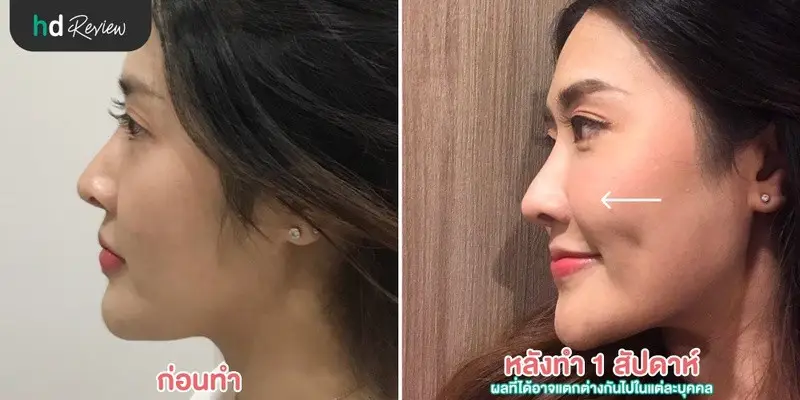 รีวิว ฉีดสารเติมเต็ม ใต้ตา ที่ Napassaree Clinic