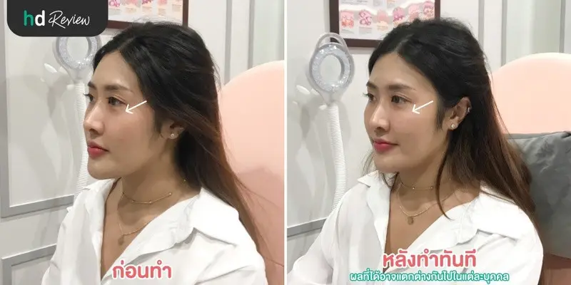 รีวิว ฉีดสารเติมเต็ม ใต้ตา ที่ Napassaree Clinic