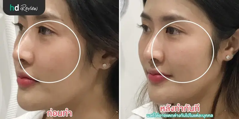 รีวิว ฉีดสารเติมเต็ม ใต้ตา ที่ Napassaree Clinic